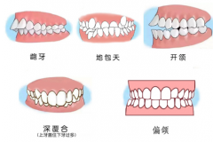做牙齿矫正的人群种类有哪些