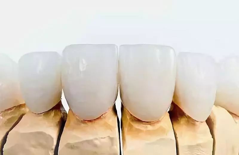 烤瓷牙和全瓷牙有什么区别？